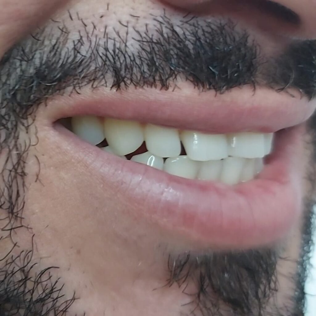 antes-2-1024×1024 antes-2-1024x1024